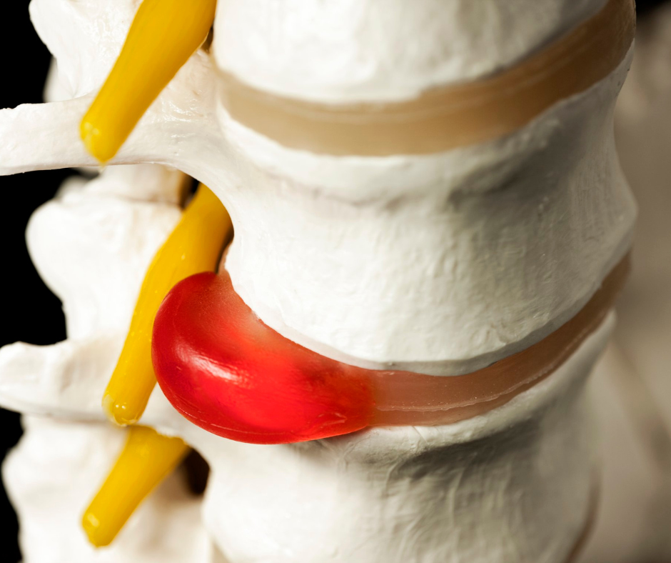 Understanding a Slipped Disc: Symptoms and Osteopathic Treatment at ...